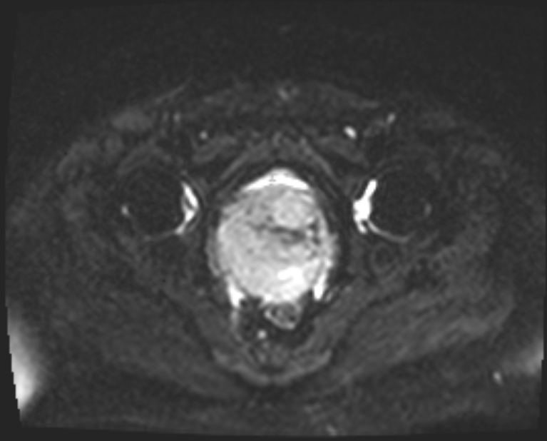 Cancer cervix - stage IIb (Radiopaedia 75411-86615 Axial DWI 11).jpg