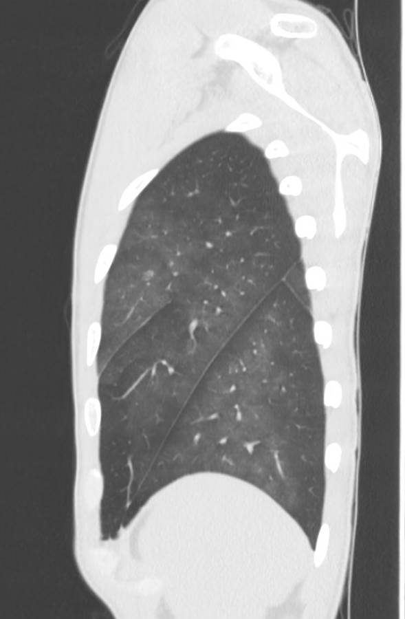 Cannabis-induced diffuse alveolar hemorrhage (Radiopaedia 89834-106946 Sagittal lung window 122).jpg