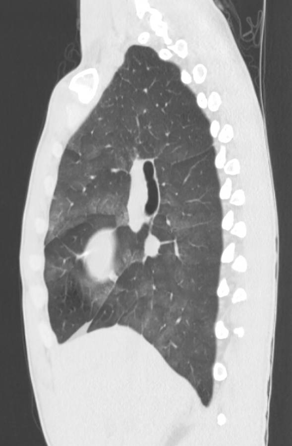 Cannabis-induced diffuse alveolar hemorrhage (Radiopaedia 89834-106946 Sagittal lung window 54).jpg