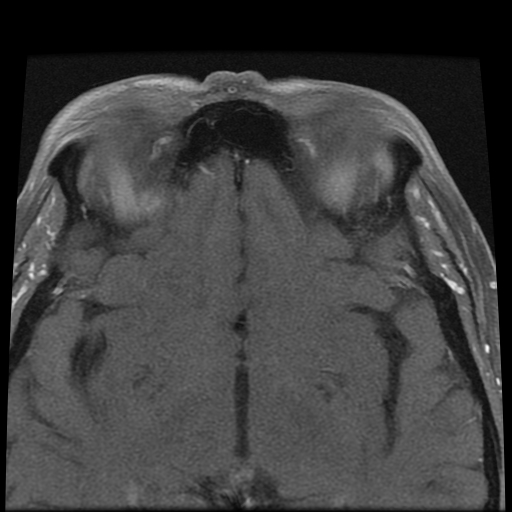 File:Carcinoid tumor of the ileum with metastasis to orbit (Radiopaedia 28165-28424 Axial T1 C+ fat sat 12).jpg