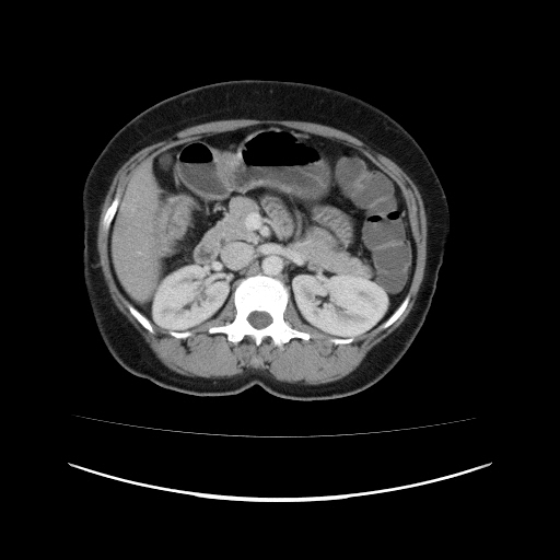 Carcinoma colon - hepatic flexure (Radiopaedia 19461-19493 A 47).jpg