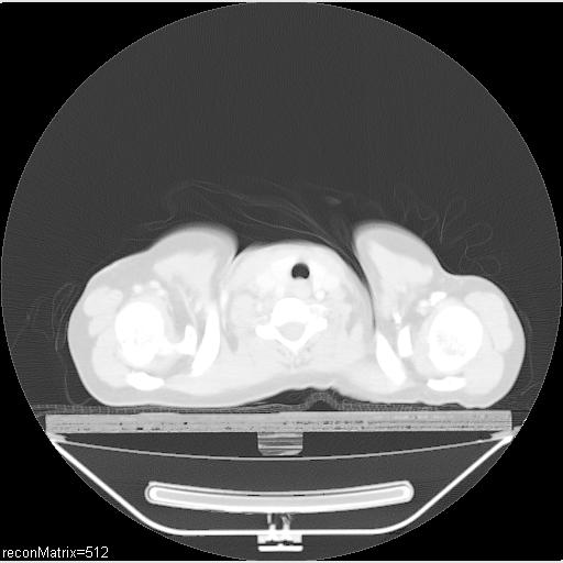File:Carcinoma of esophagus (Radiopaedia 27356-27550 Axial lung window 33).jpg