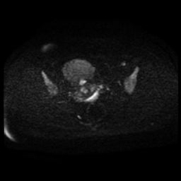 Carcinoma of the cervix (Radiopaedia 89018-105858 Axial DWI 55).jpg