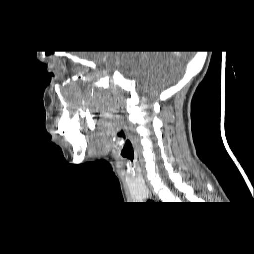 Carcinoma of the maxillary antrum (Radiopaedia 53805-59888 Sagittal C+ delayed 79).jpg