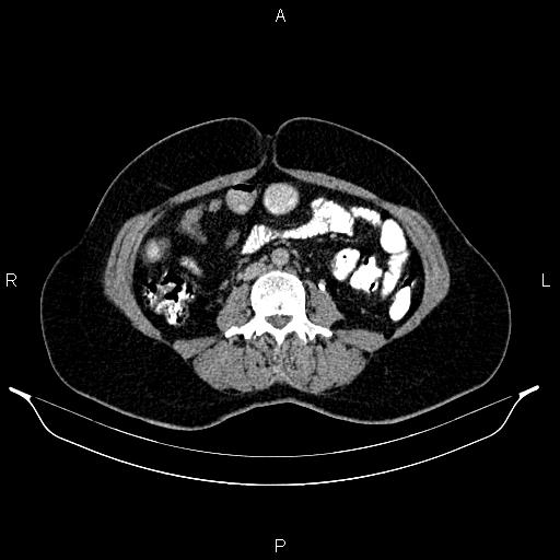 File:Carcinoma of uterine cervix (Radiopaedia 85861-101700 Axial C+ delayed 42).jpg