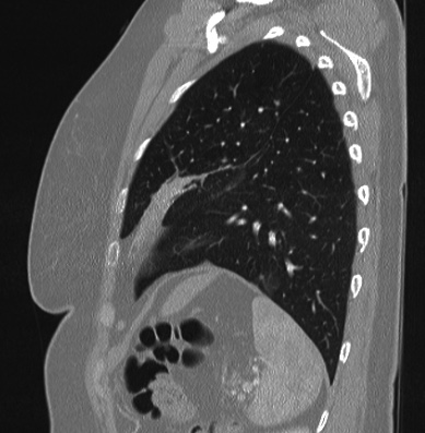 Cardiac sarcoidosis (Radiopaedia 74548-85534 Sagittal lung window 19).jpg