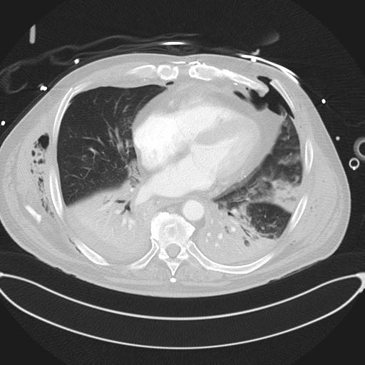 Cardiac trauma (Radiopaedia 32874-33858 Axial lung window 35).jpg