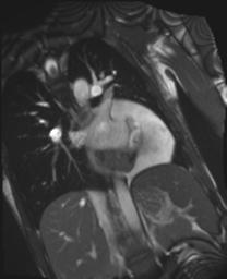 File:Cardiac tumor - undifferentiated pleomorphic sarcoma (Radiopaedia 45844-50136 Oblique T2 12).png