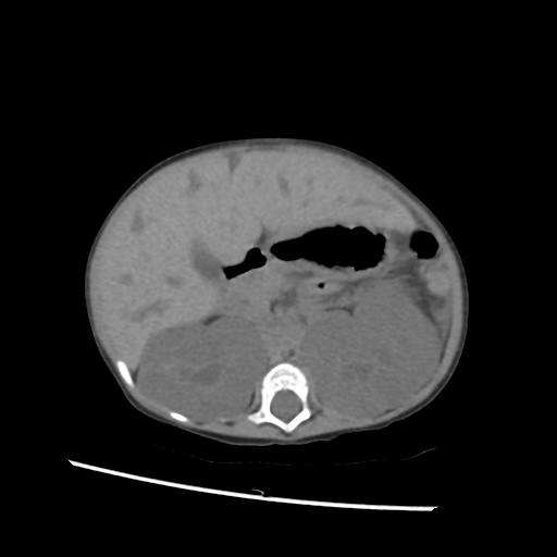 File:Caroli disease with autosomal recessive polycystic kidney disease (ARPKD) (Radiopaedia 89651-106703 Axial non-contrast 23).jpg