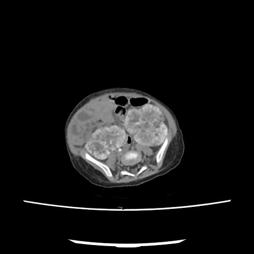 Caroli disease with autosomal recessive polycystic kidney disease (ARPKD) (Radiopaedia 89651-106703 E 172).jpg