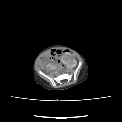 Caroli disease with autosomal recessive polycystic kidney disease (ARPKD) (Radiopaedia 89651-106703 E 181).jpg