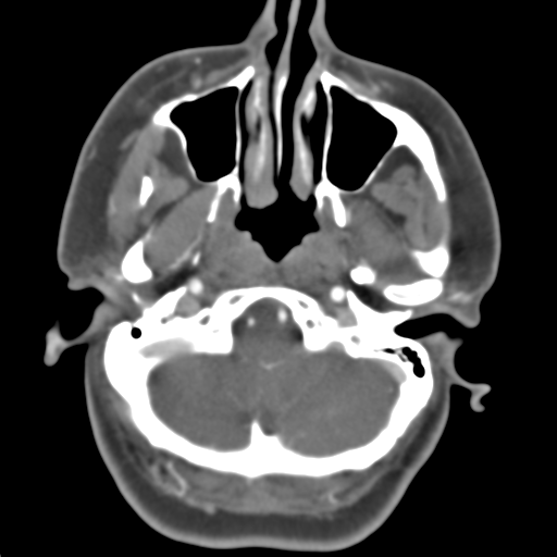 Carotico ophthalmic aneurysm (Radiopaedia 42916-46148 A 46).png