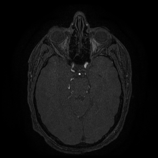 Carotid arterial dissection with acute cerebral infarction (Radiopaedia 26636-26784 MRA 105).jpg