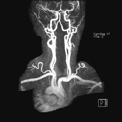 File:Carotid artery dissection (Radiopaedia 28441-28689 MIP Carotids MRA 19).jpg