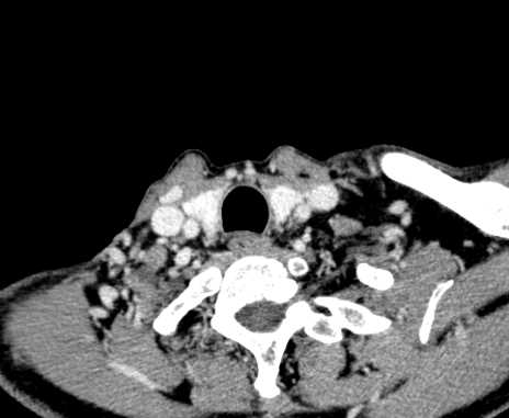 Carotid body tumor (Radiopaedia 61750-69757 Axial Post contrast 102).jpg