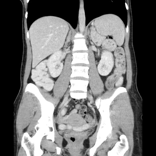 Castleman disease with fibrous pseudotumor in the abdomen (Radiopaedia 77296-89373 B 56).jpg