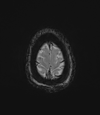 File:Cavernoma with bleed - midbrain (Radiopaedia 54546-60773 Axial SWI 45).png