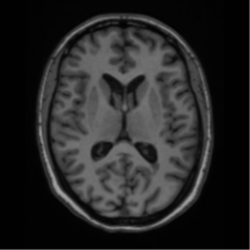 Cavernoma with bleed - midbrain (Radiopaedia 54546-60774 Axial T1 25).png