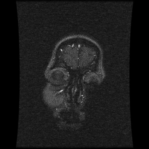 Cavernoma with developmental venous anomaly (Radiopaedia 22470-22507 MRV 117).jpg