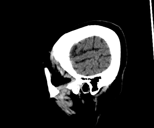 Cavernous hemangioma of the cerebellar falx (Radiopaedia 73025-83723 B 290).jpg