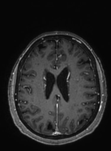 File:Cavernous hemangioma of the cerebellar falx (Radiopaedia 73025-83724 Axial T1 C+ 116).jpg