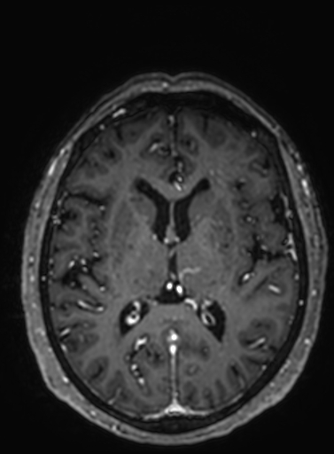 File:Cavernous hemangioma of the cerebellar falx (Radiopaedia 73025-83724 Axial T1 C+ 156).jpg