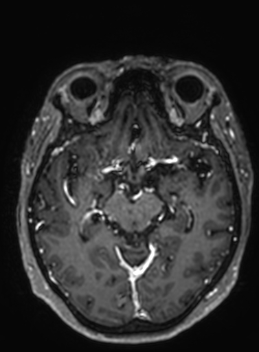 Cavernous hemangioma of the cerebellar falx (Radiopaedia 73025-83724 Axial T1 C+ 196).jpg