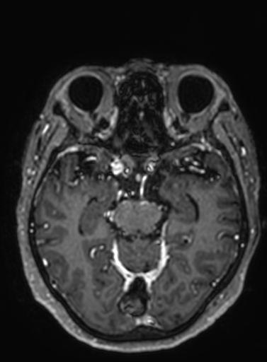 Cavernous hemangioma of the cerebellar falx (Radiopaedia 73025-83724 Axial T1 C+ 206).jpg