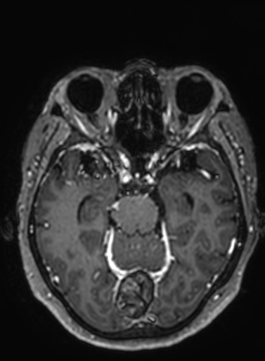 File:Cavernous hemangioma of the cerebellar falx (Radiopaedia 73025-83724 Axial T1 C+ 212).jpg