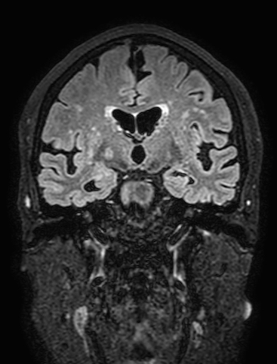 Cavernous hemangioma of the cerebellar falx (Radiopaedia 73025-83724 Coronal FLAIR 166).jpg