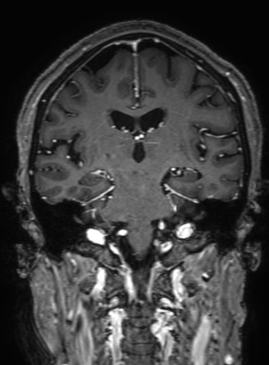 Cavernous hemangioma of the cerebellar falx (Radiopaedia 73025-83724 Coronal T1 C+ 212).jpg