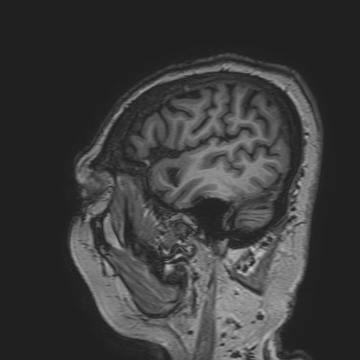 File:Cavernous hemangioma of the cerebellar falx (Radiopaedia 73025-83724 Sagittal T1 35).jpg