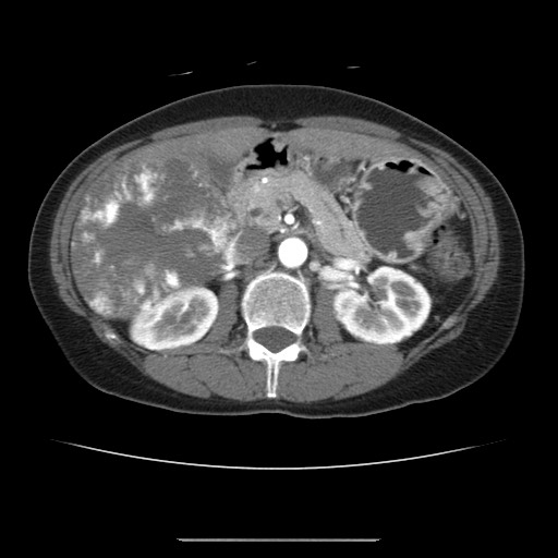 Cavernous hepatic hemangioma (Radiopaedia 75441-86667 A 45).jpg
