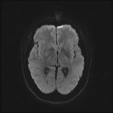 Cavernous sinus meningioma (Radiopaedia 63682-72367 DWI 52).jpg