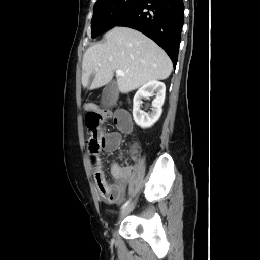 Cecal adenocarcinoma (Radiopaedia 75909-87331 C 26).jpg