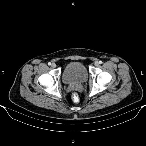 Cecal adenocarcinoma (Radiopaedia 85324-100916 B 95).jpg