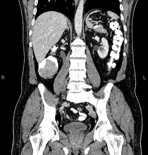 Cecal adenocarcinoma (Radiopaedia 85324-100916 D 41).jpg