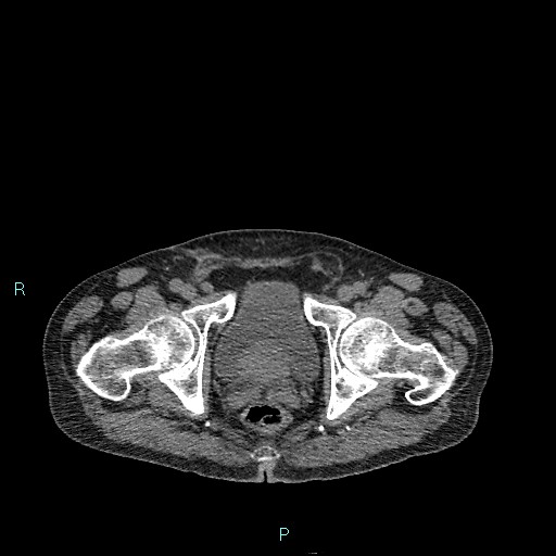 Cecal bascule (Radiopaedia 85770-101586 Axial non-contrast 103).jpg