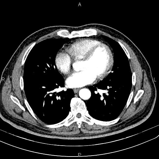 File:Cecal cancer with appendiceal mucocele (Radiopaedia 91080-108651 A 41).jpg