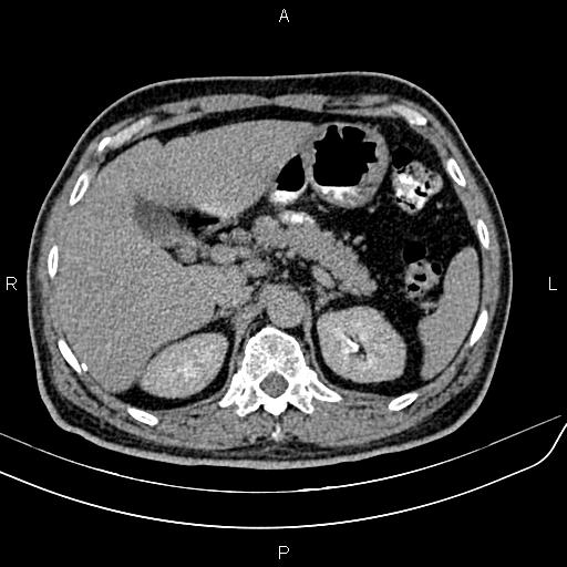 File:Cecal cancer with appendiceal mucocele (Radiopaedia 91080-108651 Axial C+ delayed 10).jpg