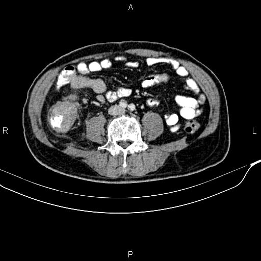 Cecal cancer with appendiceal mucocele (Radiopaedia 91080-108651 B 64).jpg