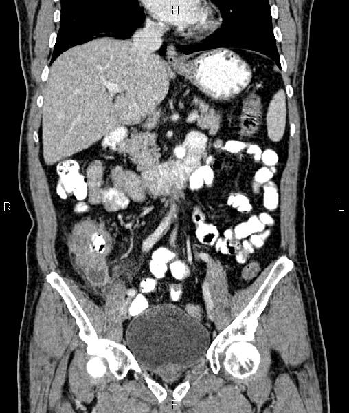 Cecal cancer with appendiceal mucocele (Radiopaedia 91080-108651 D 35).jpg