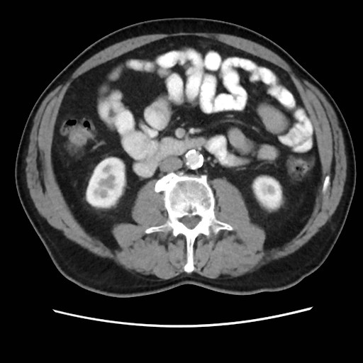 Cecal mass causing appendicitis (Radiopaedia 59207-66531 A 44).jpg