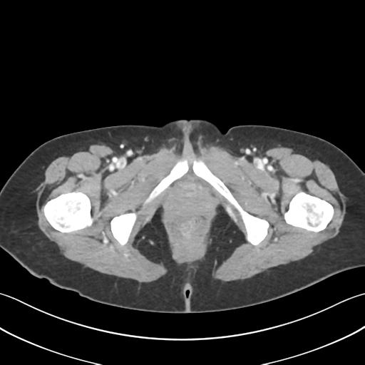 File:Cecum hernia through the foramen of Winslow (Radiopaedia 46634-51112 A 78).png