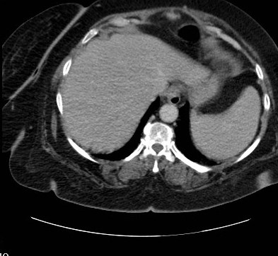 File:Celiac artery compression syndrome (Radiopaedia 24287-24570 B 1).jpg