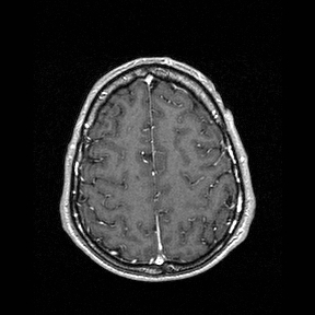 Central-variant posterior reversible encephalopathy syndrome (PRES) (Radiopaedia 43880-47358 Axial T1 C+ 134).jpg
