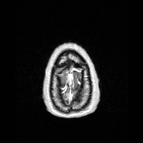 Central-variant posterior reversible encephalopathy syndrome (PRES) (Radiopaedia 43880-47358 Axial T1 C+ 163).jpg