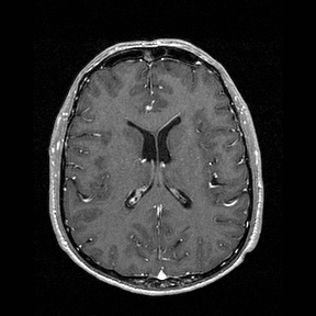 Central-variant posterior reversible encephalopathy syndrome (PRES) (Radiopaedia 43880-47358 Axial T1 C+ 97).jpg