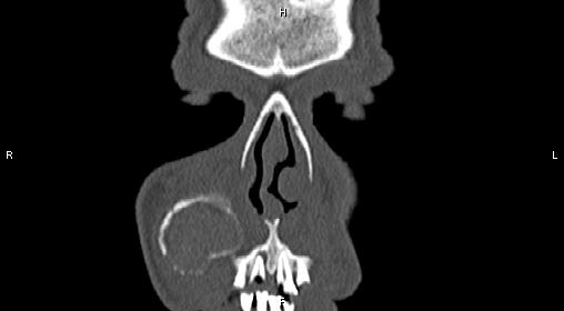 File:Central giant cell granuloma (Radiopaedia 83346-97761 Coronal bone window 3).jpg