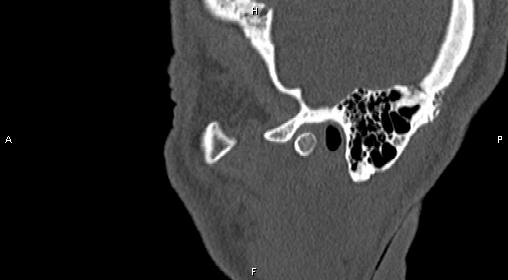 File:Central giant cell granuloma (Radiopaedia 83346-97761 Sagittal bone window 44).jpg